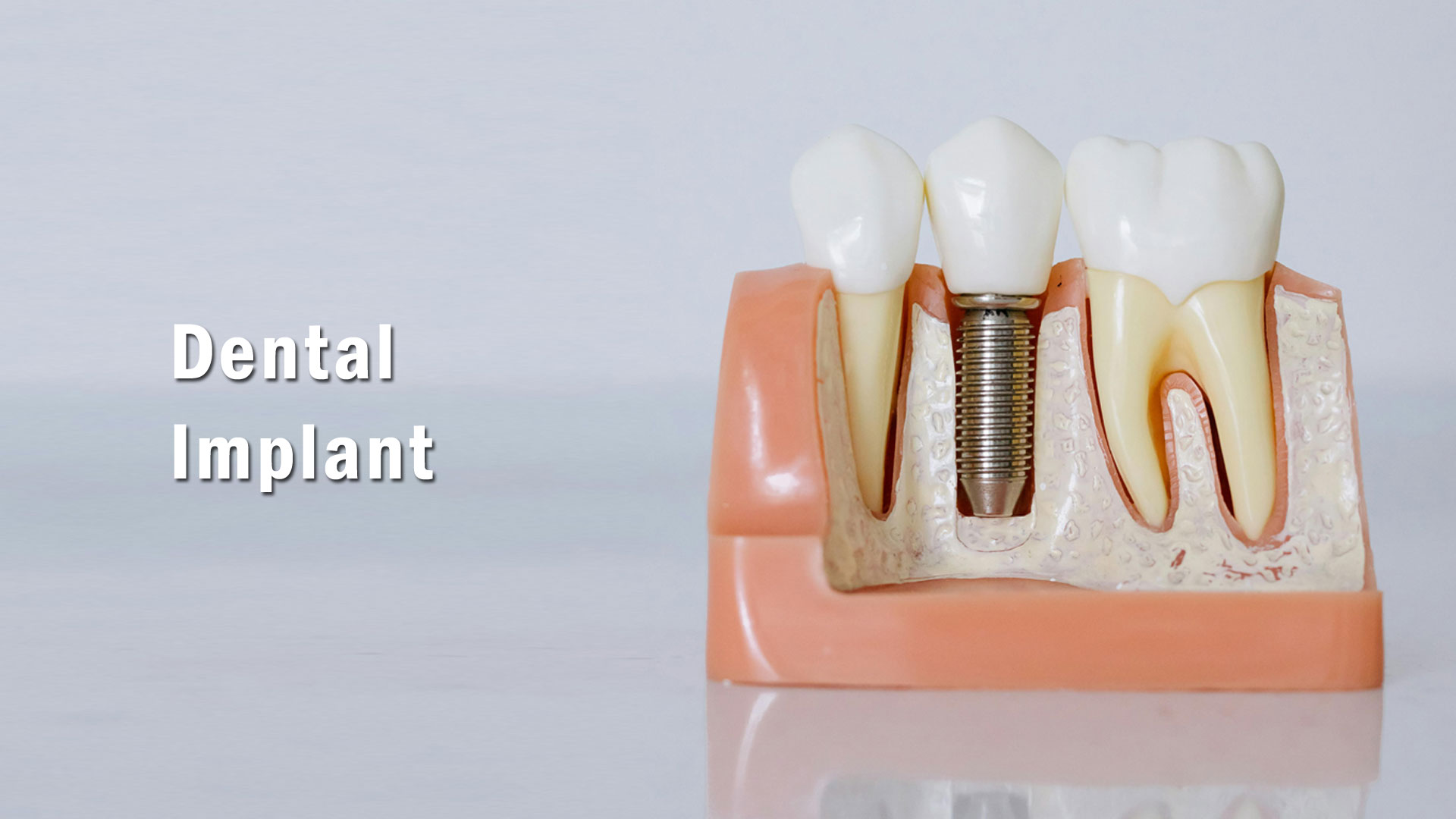 Dental İmplant