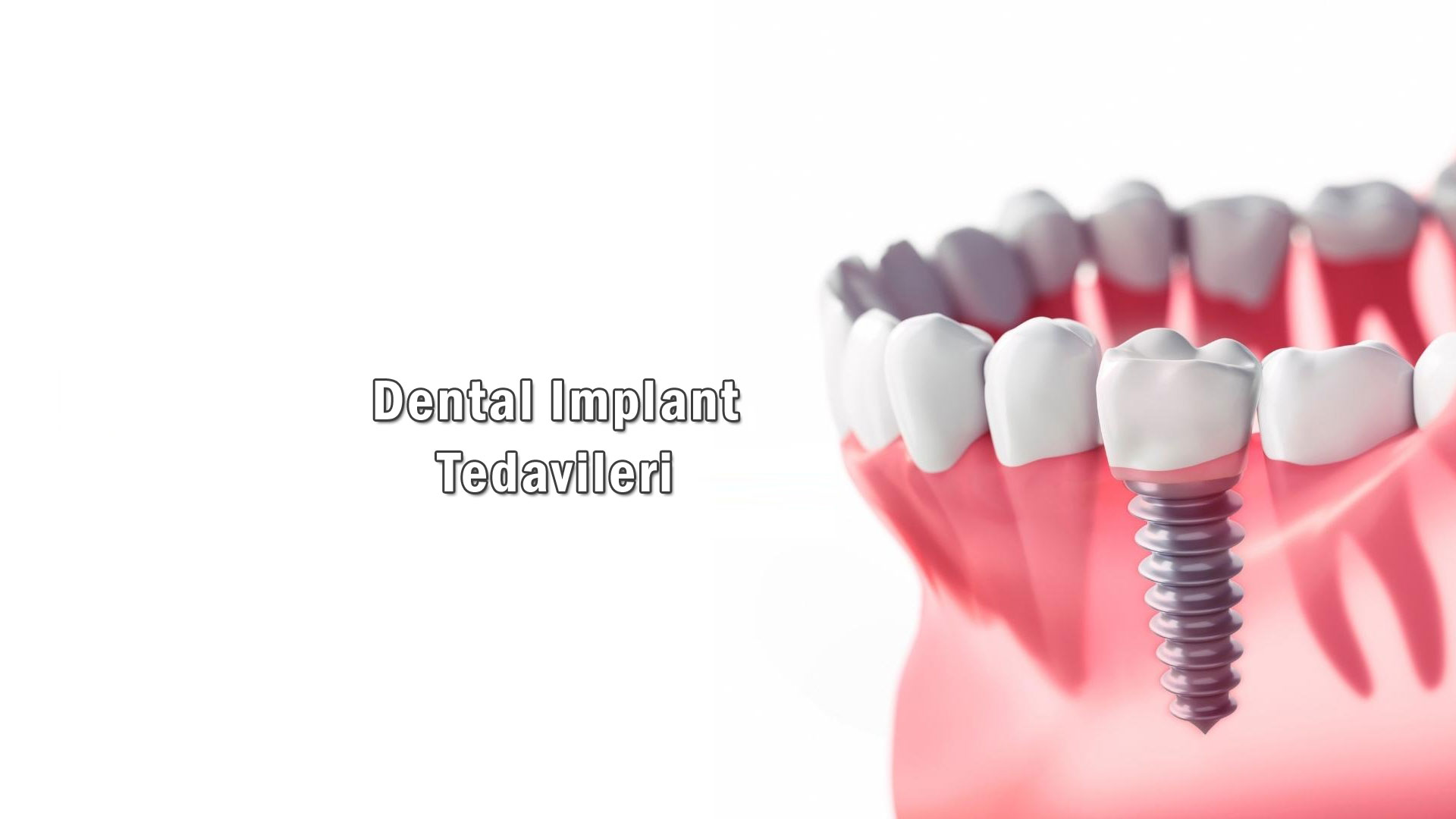 Dental İmplant Tedavileri