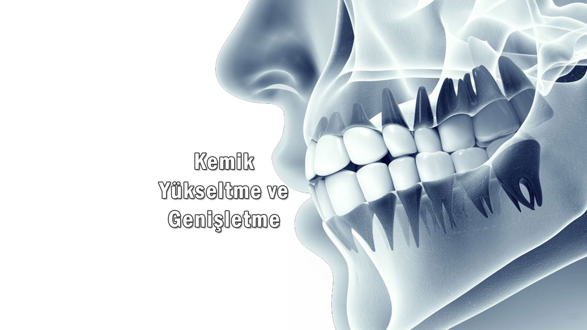 Kemik Yükseltme ve Genişletme