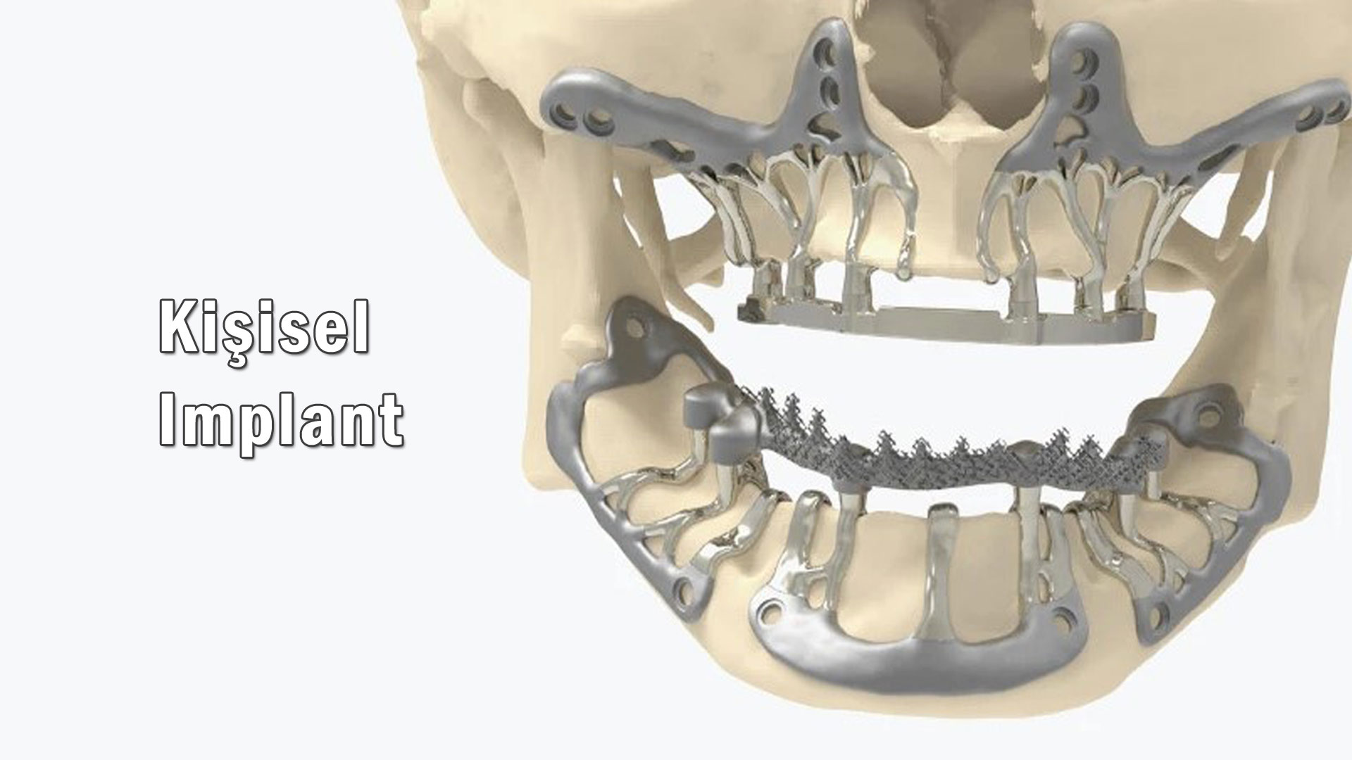 Kişisel 3D İmplant