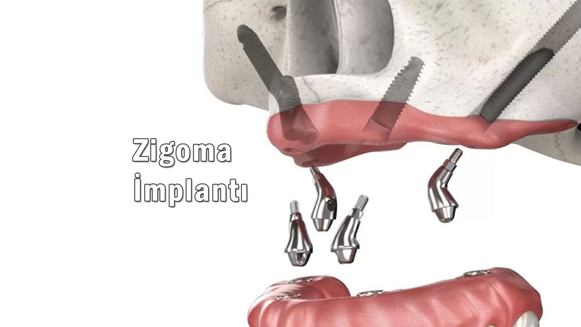 Zigoma İmplantı